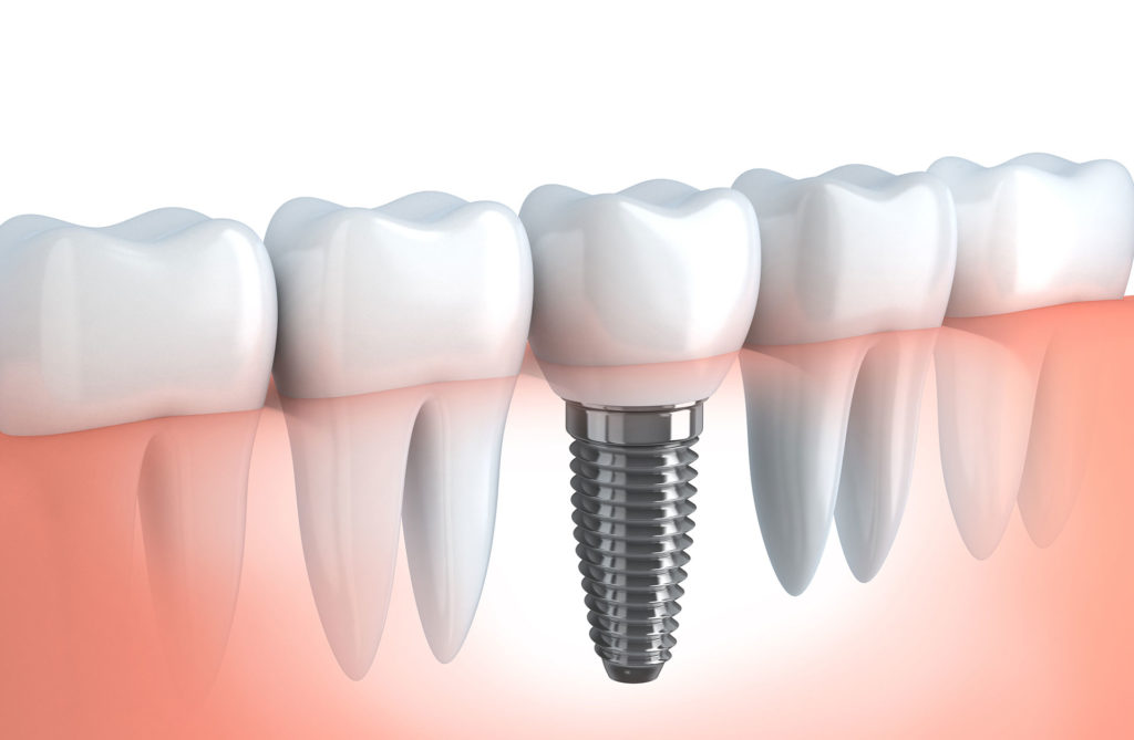 affordable dental implants