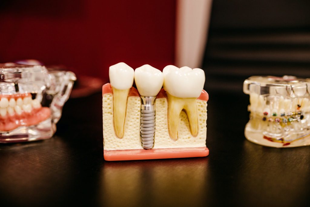 Partial dentures are a great way to makeover your smile, and Jamestowne South Dental Cracchiolo, Jr. can help with any of the many types of partial dentures currently available. Keywords: types of partial dentures