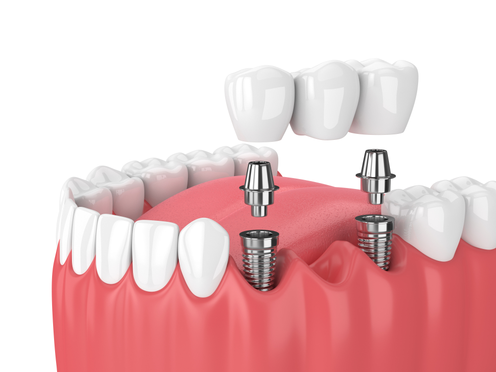 dental bridge vs implant