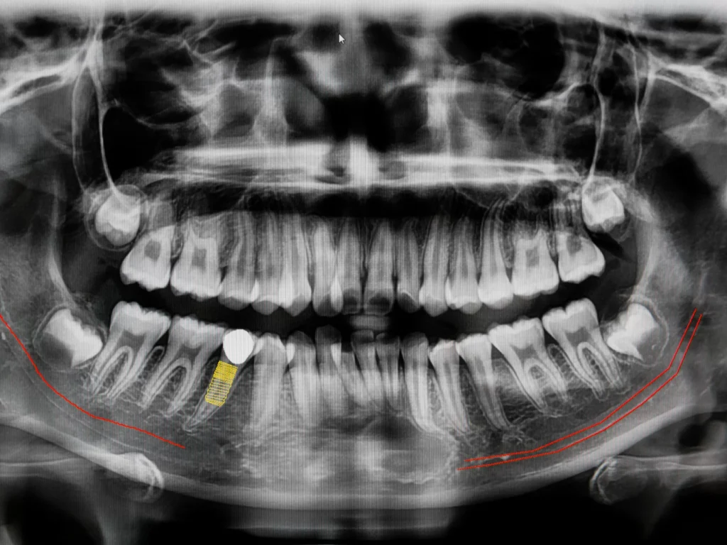 digital x-ray