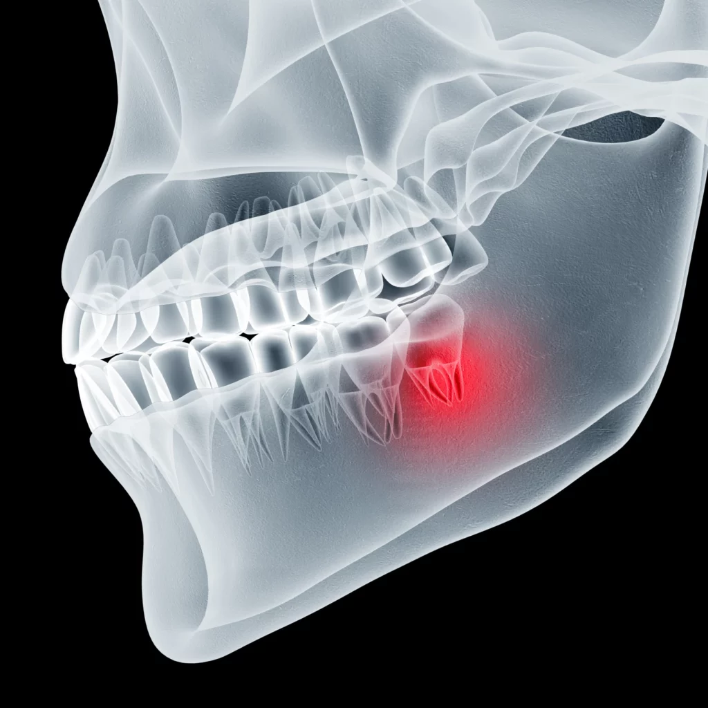 wisdom teeth removal in Bingham Farms, MI