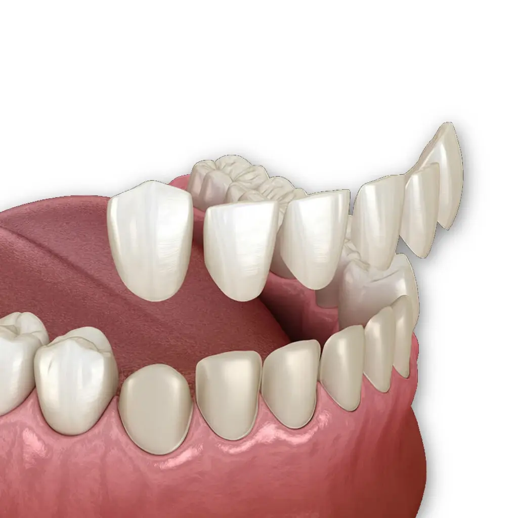 model of porcelain veneers