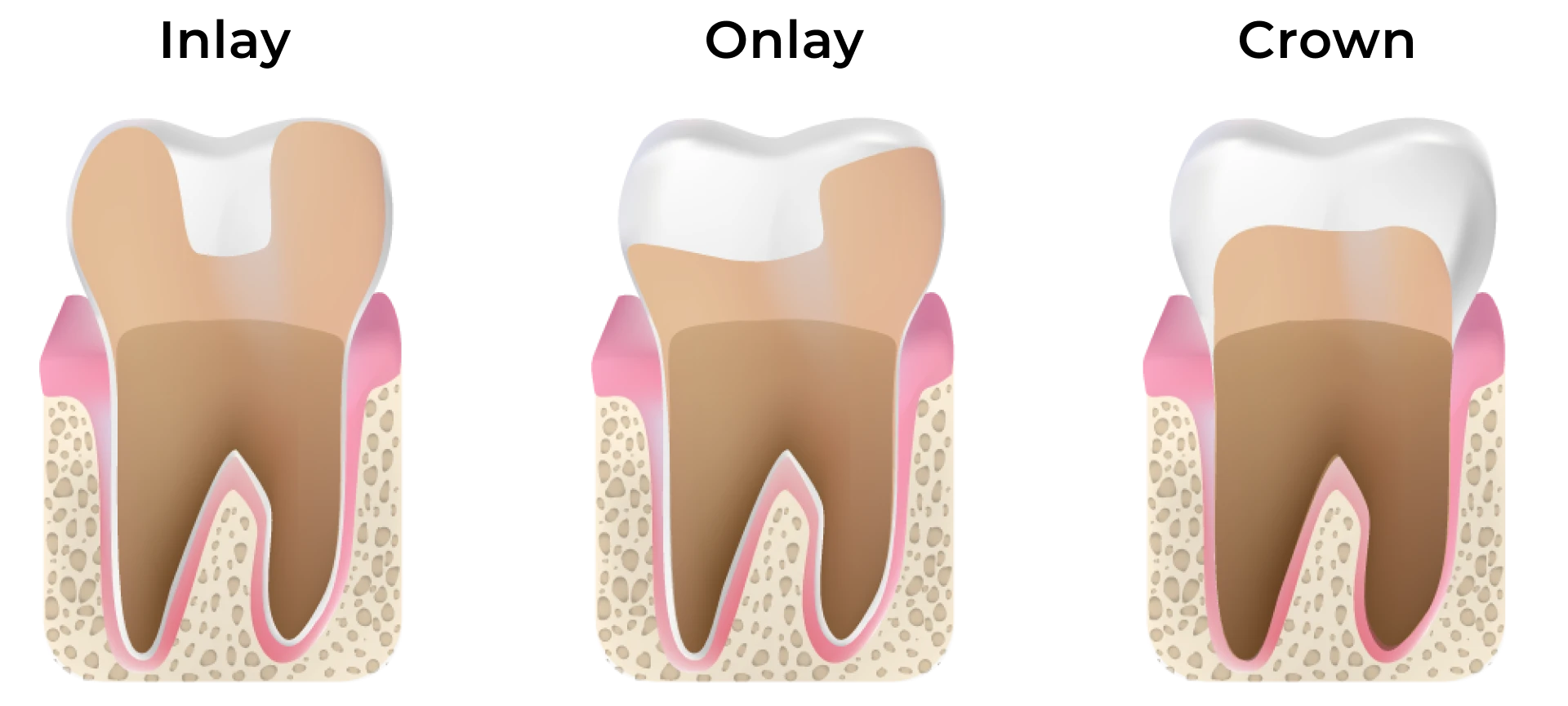 graphic of inlay vs onlay vs crown