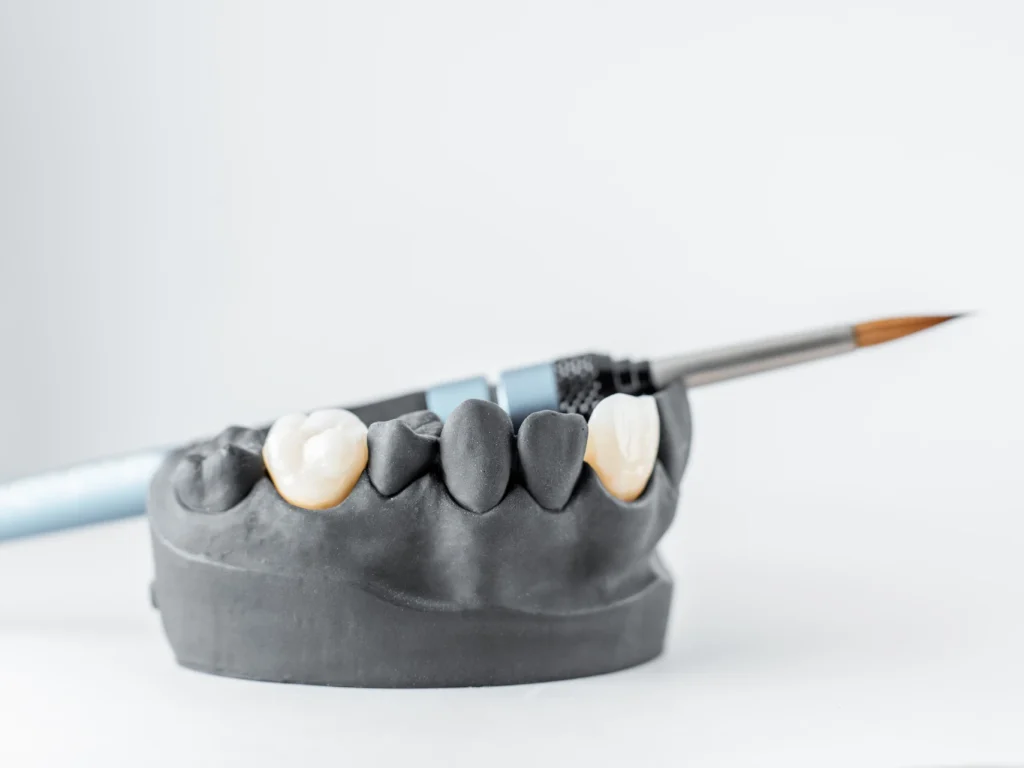 jaw model with dental crowns | types of dental crowns